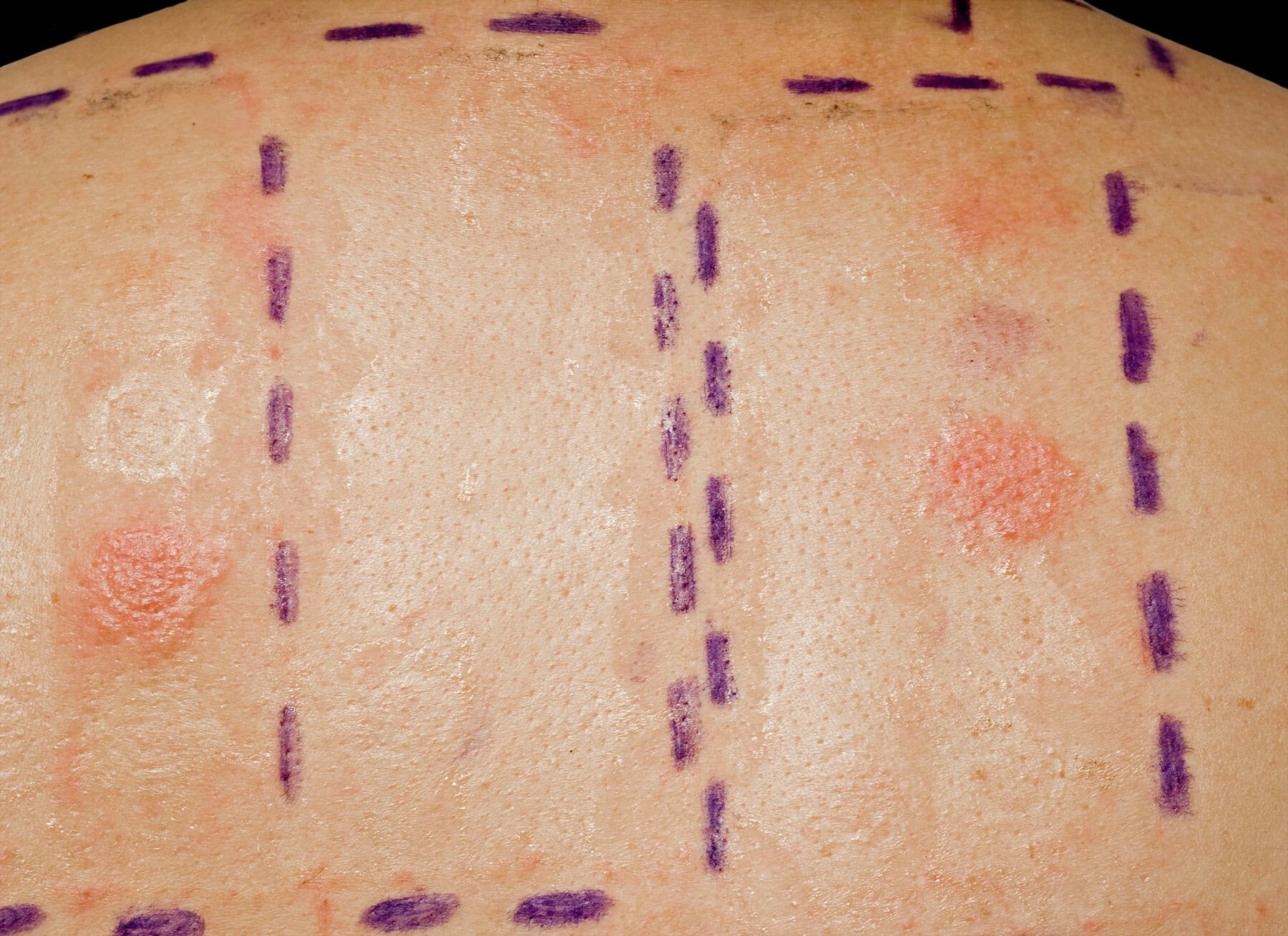 Skin,Allergy,Patch,Test,On,Back,Of,Patient,Showing,Redness