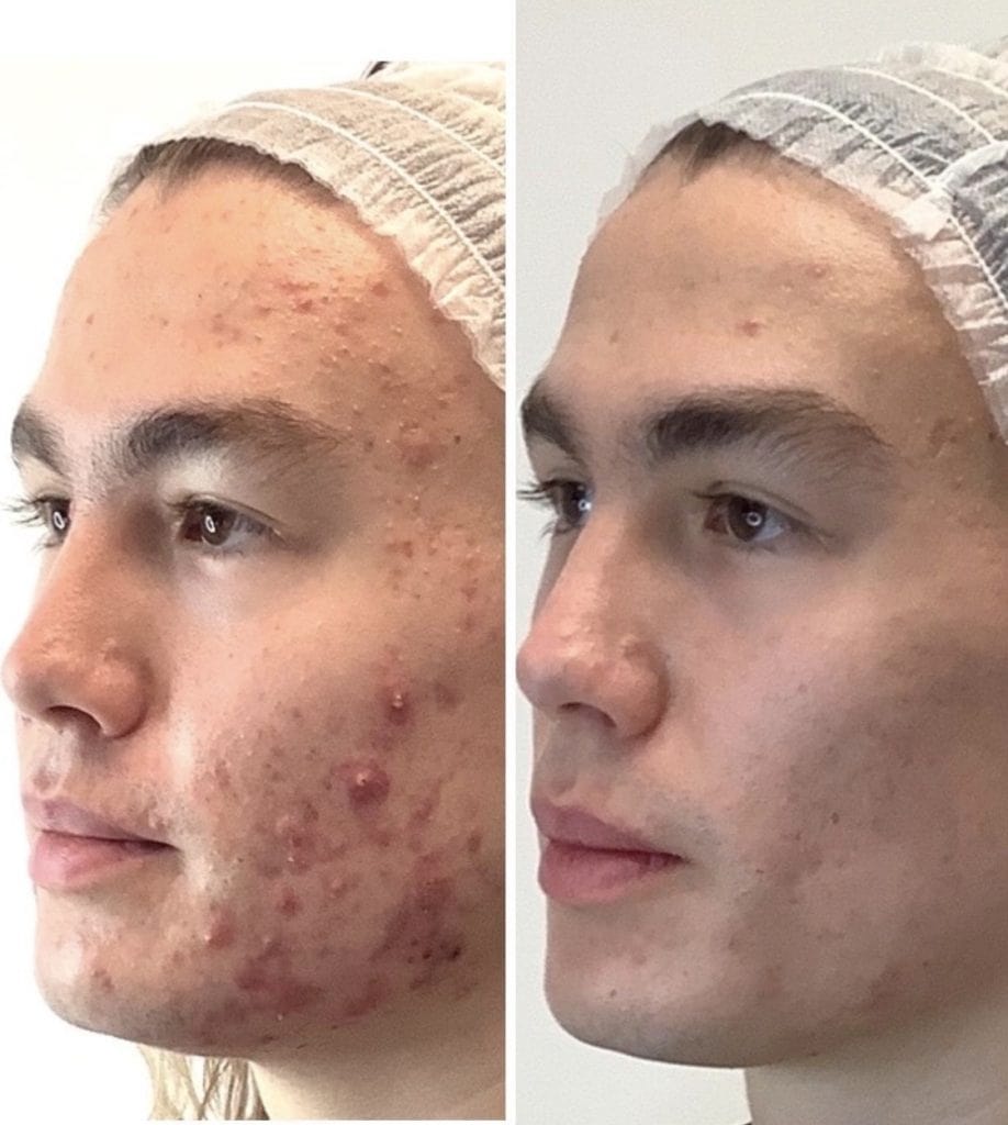acne treatment